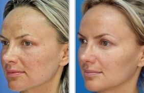 Laserové peeling
