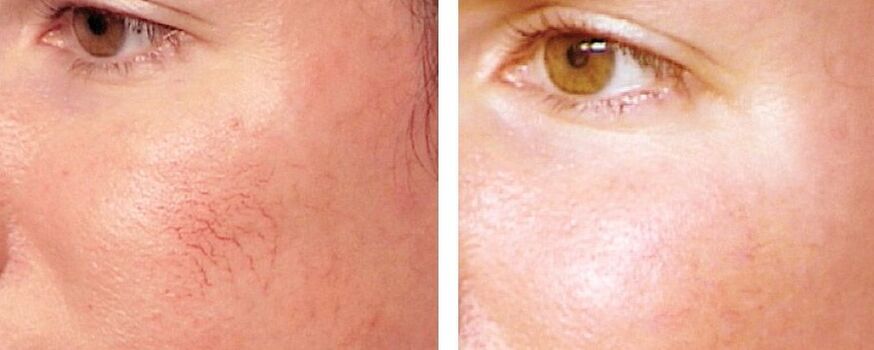 Odstranění rosacea