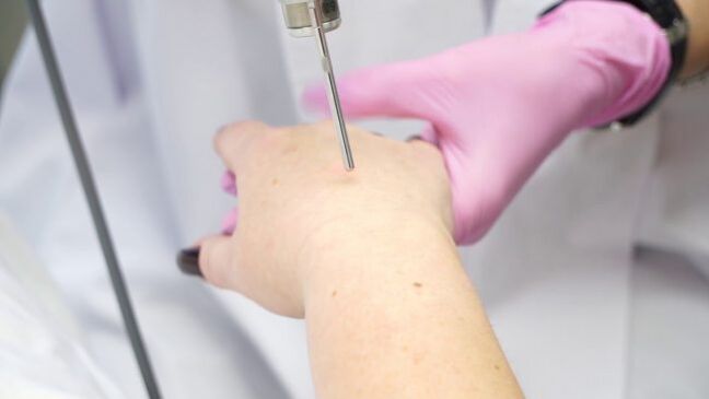 Laserové omlazení pokožky rukou